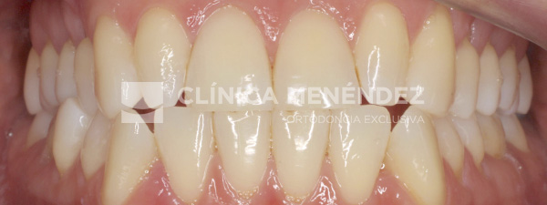 21 CLASE III CON MICRODONCIA DE INCISIVOS LATERALES SUPERIROES TRATADA CON INVISALIGN + ESTETICA DENTAL INICIO