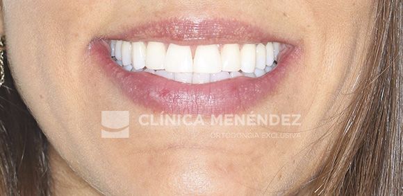 21 CLASE III CON MICRODONCIA DE INCISIVOS LATERALES SUPERIROES TRATADA CON INVISALIGN + ESTETICA DENTAL FIN