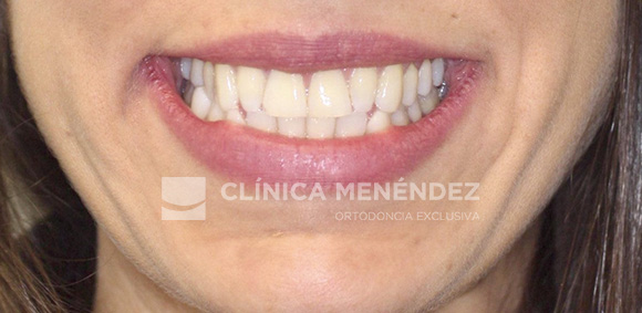 21 CLASE III CON MICRODONCIA DE INCISIVOS LATERALES SUPERIROES TRATADA CON INVISALIGN + ESTETICA DENTAL INICIO