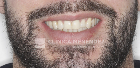 3 CLASE I MORDIDA CRUZADA ANTERIOR Y POSTERIOR TRATADO CON INVISALIGN FIN