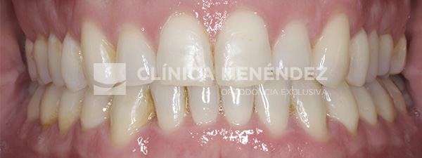 3 CLASE I MORDIDA CRUZADA ANTERIOR Y POSTERIOR TRATADO CON INVISALIGN Fin (1)