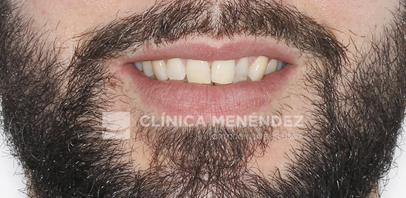 3 CLASE I MORDIDA CRUZADA ANTERIOR Y POSTERIOR TRATADO CON INVISALIGN INICIO
