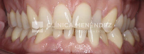 3 CLASE I MORDIDA CRUZADA ANTERIOR Y POSTERIOR TRATADO CON INVISALIGN Inicio (1)