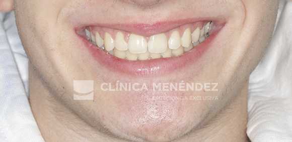 avance mandibular niños después