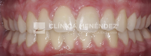 4 CLASE II CON AVANCE MANDIBULAR TRATADO CON ORTOPEDIA DENTOFACIAL + BRACKETS METÁLICOS EN NIÑO Fin