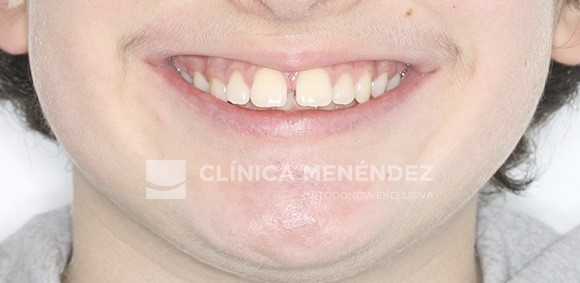 avance mandibular niños antes