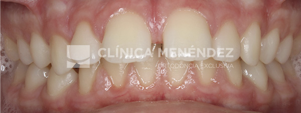4 CLASE II CON AVANCE MANDIBULAR TRATADO CON ORTOPEDIA DENTOFACIAL + BRACKETS METÁLICOS EN NIÑO Inicio