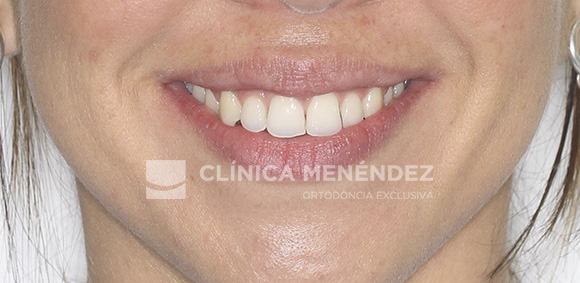 5 CLASE I CON MORDIDA ABIERTA TRATADO CON INVISALIGN FIN
