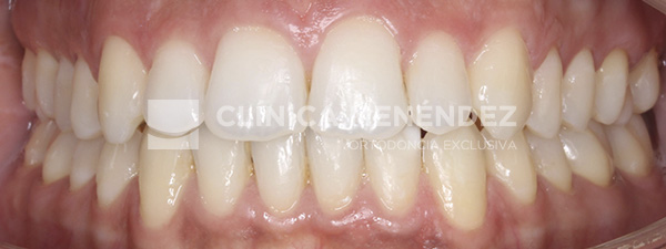 5 CLASE I CON MORDIDA ABIERTA TRATADO CON INVISALIGN Fin (1)