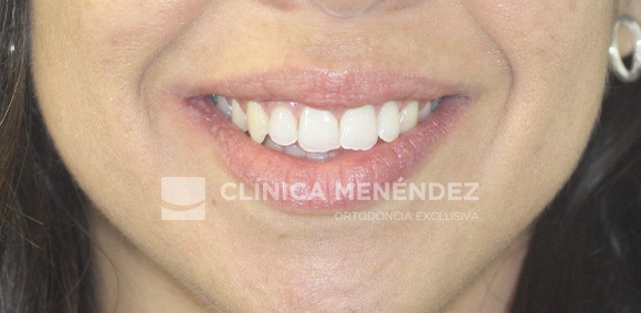 5 CLASE I CON MORDIDA ABIERTA TRATADO CON INVISALIGN INICIO