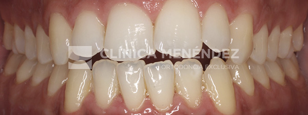 5 CLASE I CON MORDIDA ABIERTA TRATADO CON INVISALIGN Inicio (1)