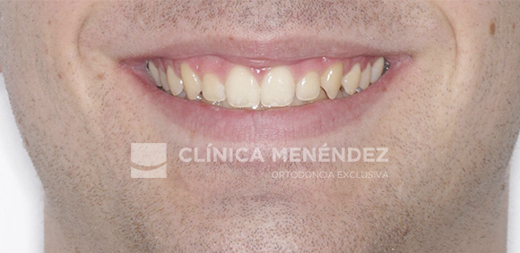 6 CLASE II CON SOBREMORDIDA TRATADO CON INVISALIGN FIN (1)