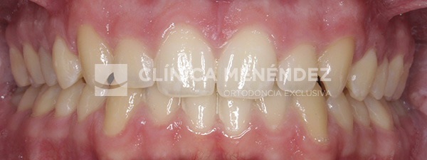 6 CLASE II CON SOBREMORDIDA TRATADO CON INVISALIGN Fin