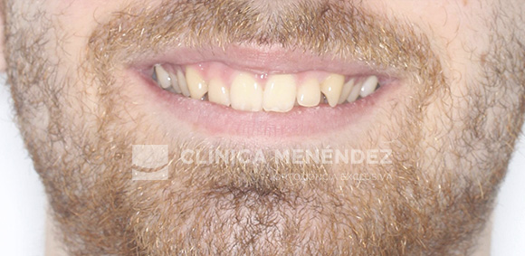 6 CLASE II CON SOBREMORDIDA TRATADO CON INVISALIGN INICIO