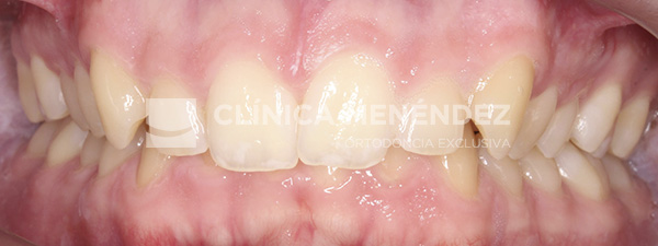 6 CLASE II CON SOBREMORDIDA TRATADO CON INVISALIGN Incio
