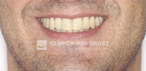 7 CLASE I APIÑAMIENTO TRATADO CON BRACKETS METÁLICOS FIN
