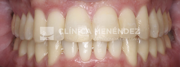 7 CLASE I APIÑAMIENTO TRATADO CON BRACKETS METÁLICOS Fin
