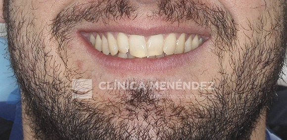 7 CLASE I APIÑAMIENTO TRATADO CON BRACKETS METÁLICOS INICIO