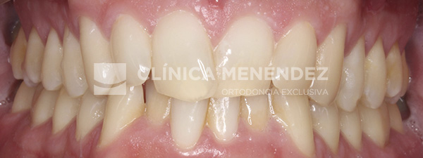 7 CLASE I APIÑAMIENTO TRATADO CON BRACKETS METÁLICOS Inicio