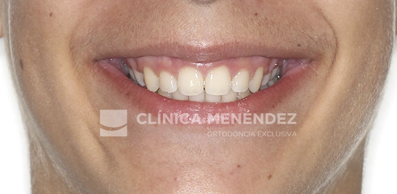 8 CLASE II SEVERA CON SOBREMORDIDA TRATADO CON ORTOPEDIA DENTOFACIAL + BRACKETS METÁLICOS EN NIÑO FIN