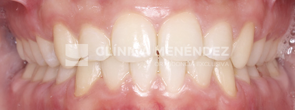 8 CLASE II SEVERA CON SOBREMORDIDA TRATADO CON ORTOPEDIA DENTOFACIAL + BRACKETS METÁLICOS EN NIÑO Fin