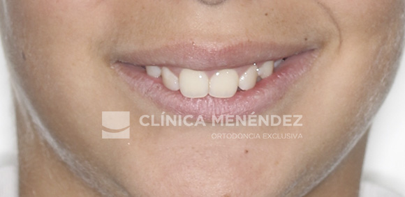 8 CLASE II SEVERA CON SOBREMORDIDA TRATADO CON ORTOPEDIA DENTOFACIAL + BRACKETS METÁLICOS EN NIÑO INICIO