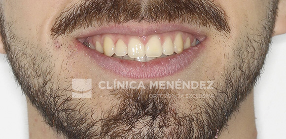 9 CLASE I MORDIDA ABIERTA Y DIASTEMA CENTRAL TRATADO CON INVISALIGN FIN