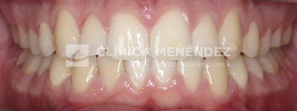 9 CLASE I MORDIDA ABIERTA Y DIASTEMA CENTRAL TRATADO CON INVISALIGN Fin (1)