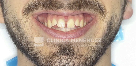 9 CLASE I MORDIDA ABIERTA Y DIASTEMA CENTRAL TRATADO CON INVISALIGN INICIO