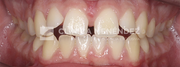 9 CLASE I MORDIDA ABIERTA Y DIASTEMA CENTRAL TRATADO CON INVISALIGN Inicio (1)