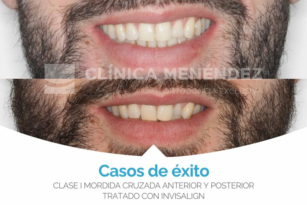 Clase I Mordida cruzada anterior y posterior tratado con Invisalign antes y después