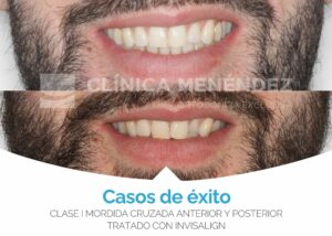 Clase I Mordida cruzada anterior y posterior tratado con Invisalign antes y después