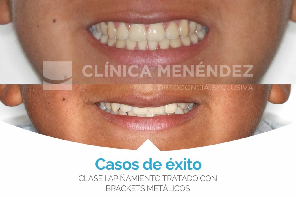 Clase I apiñamiento tratado con brackets metálicos
