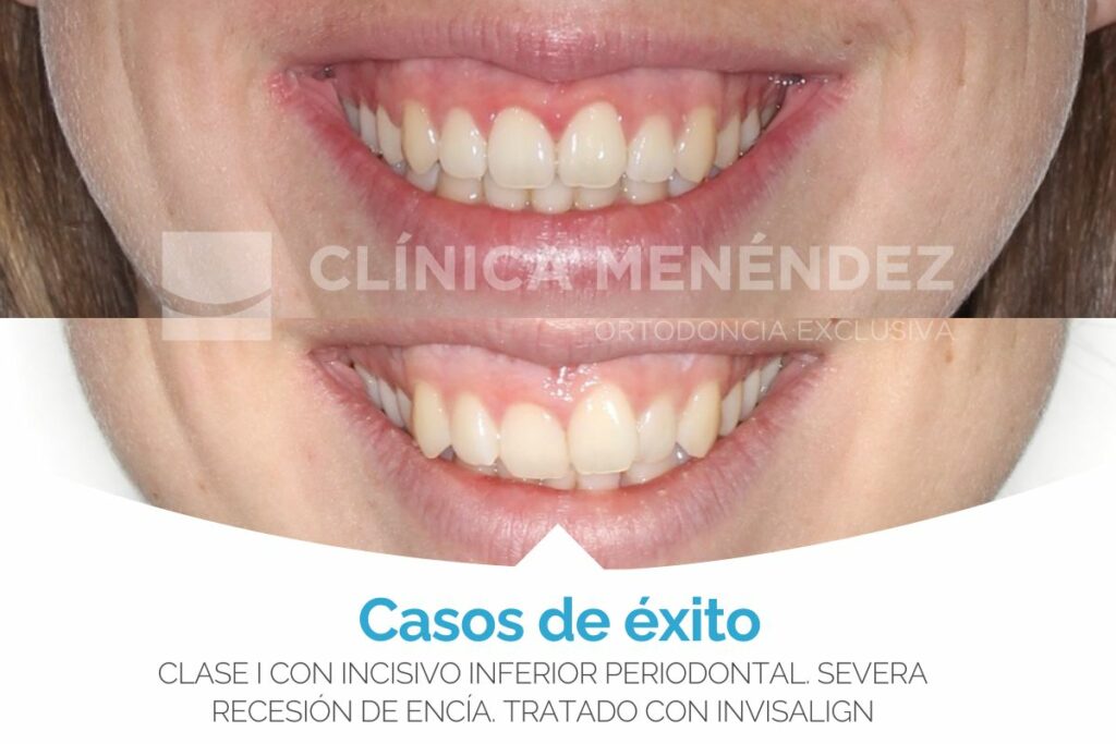 Clase I con incisivo inferior periodontal severa encía tratado con brackets metálicos