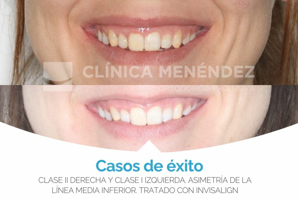 Clase II derecho y clase I izquierda asimetría de la línea media inferior tratado con Invisalign antes y después