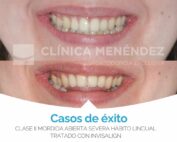 Clase II mordida abierta severa por hábito lingual tratado con Invisalign