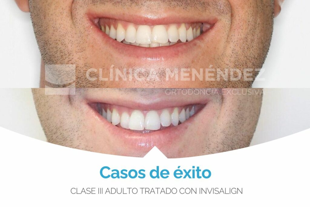 Clase III adulto tratado con Invisalign antes y después