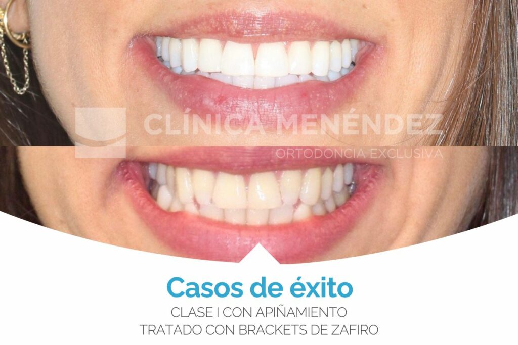 Clase III con microdoncia de incisivos laterales superiores tratada con Invisalign + estética dental antes y después