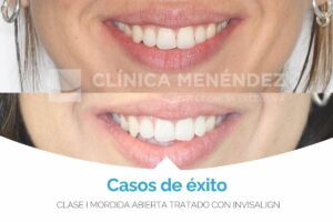 clase 1 mordida abierta tratado con invisalign antes y después