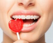 brackets ceramica vs zafiro diferencias