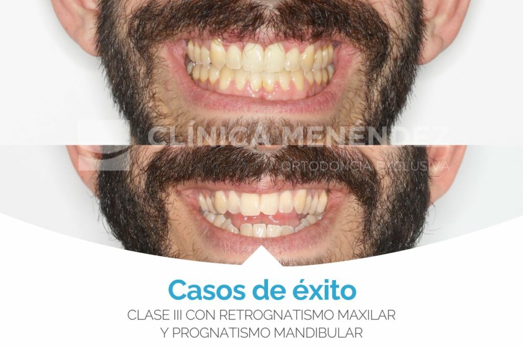 cirugia ortognatica retrognatismo maxilar prognatismo mandibular antes y después