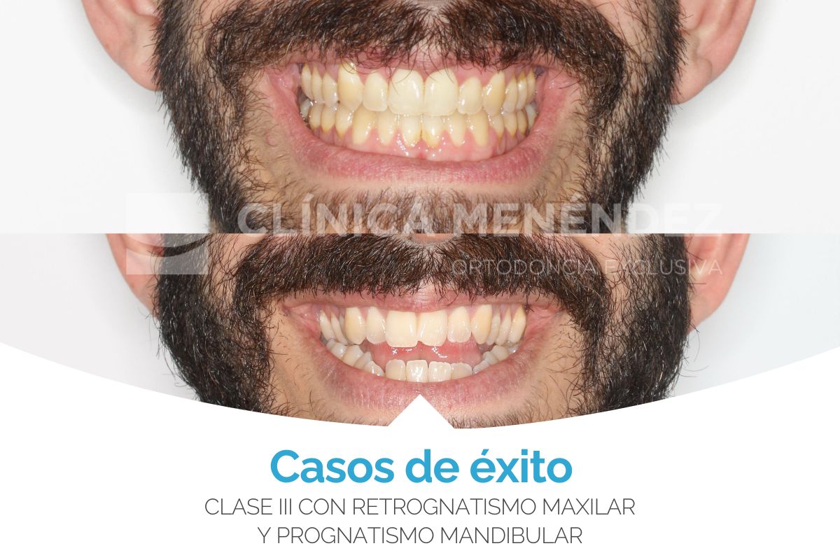 cirugia ortognatica retrognatismo maxilar prognatismo mandibular