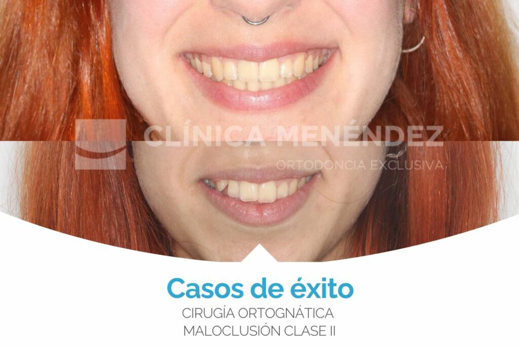caso cirugia ortognatica maloclusion clase II antes y después