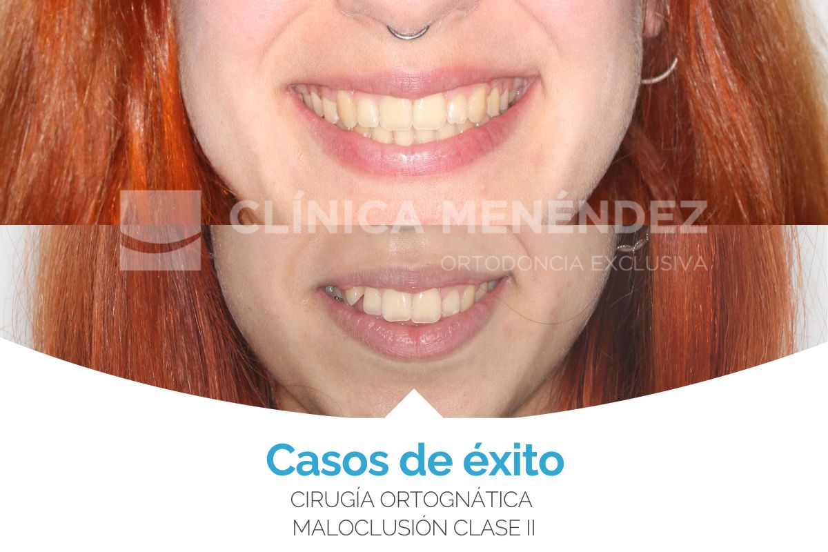 caso cirugia ortognatica maloclusion clase II