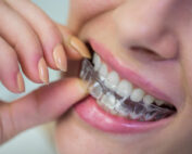 Refinamiento en Invisalign