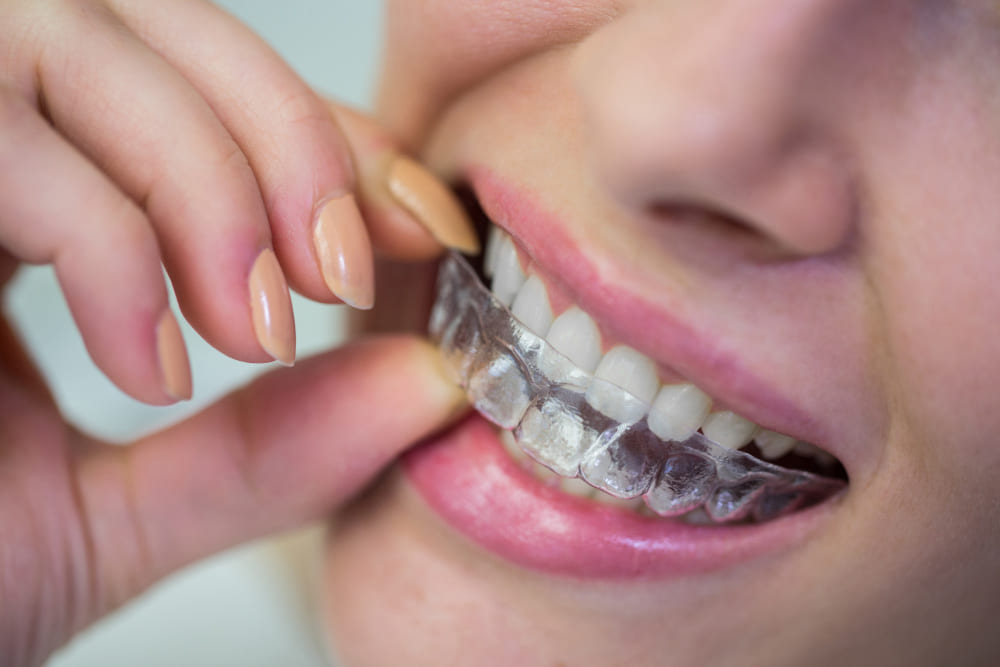 Refinamiento en Invisalign Refinamiento en Invisalign