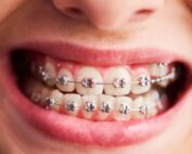 duelen los microtornillos en ortodoncia