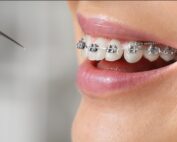 llagas causadas por brackets