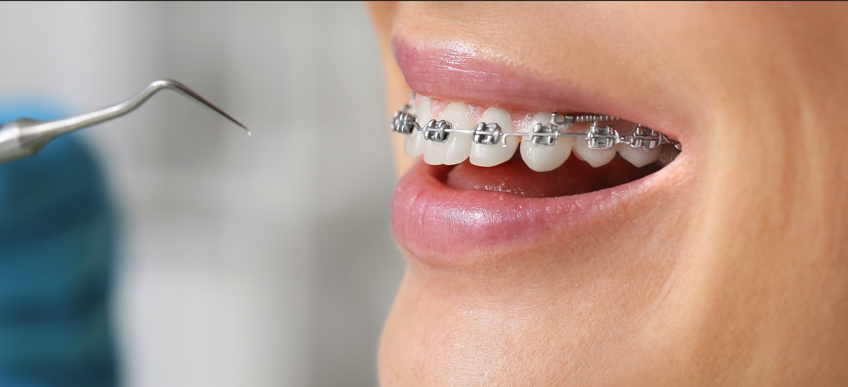 llagas causadas por brackets llagas causadas por brackets