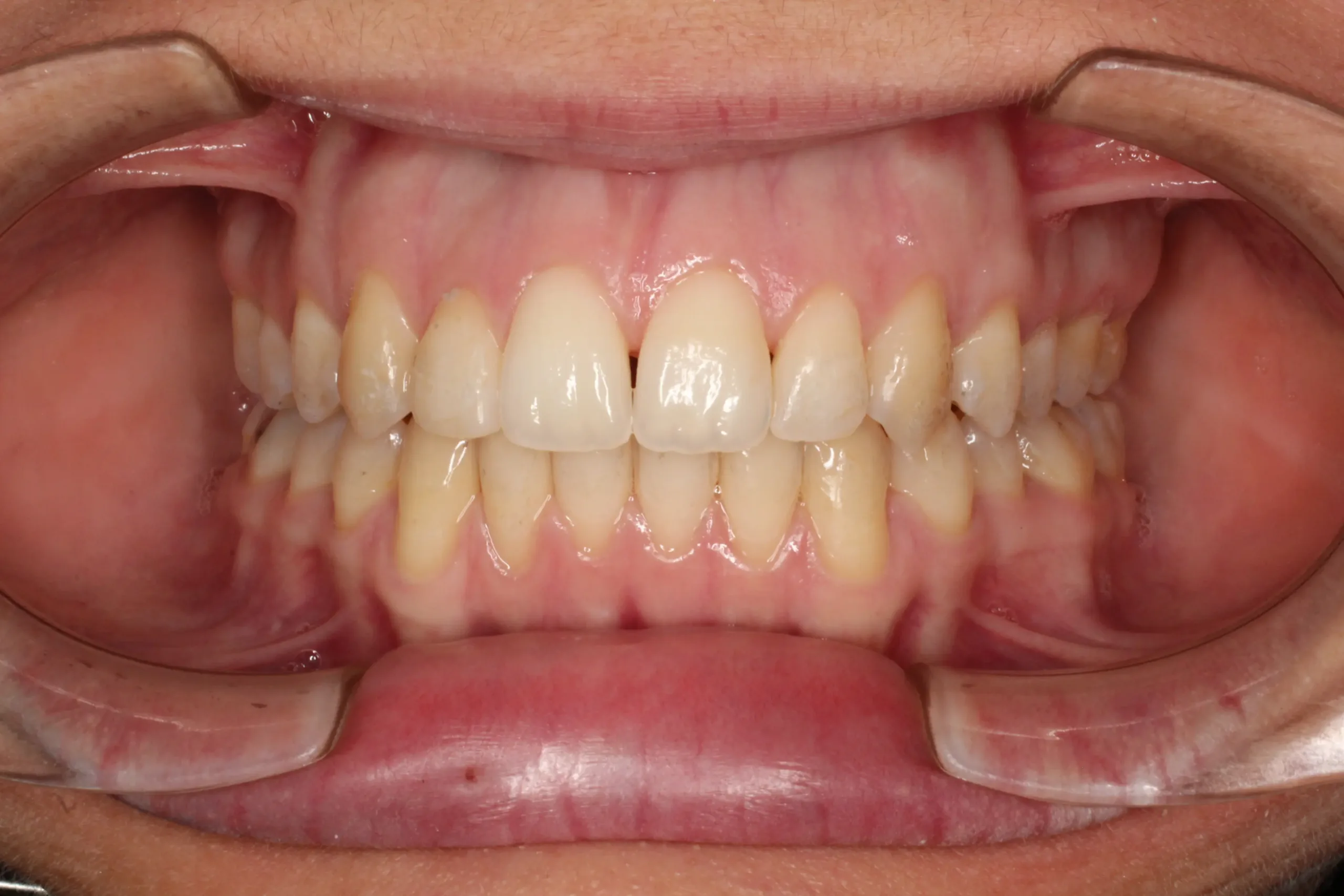 Imagen después del tratamiento